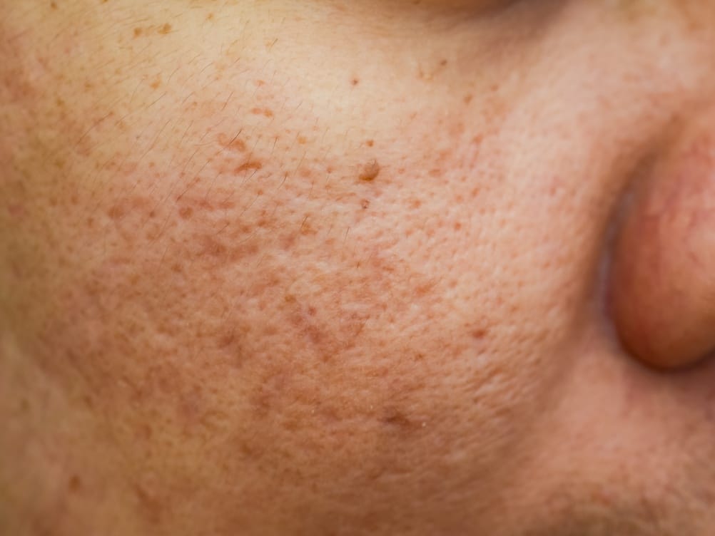 Littekens behandeling bij Younique Skincare